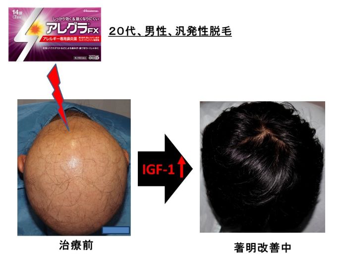 円形脱毛症　病院